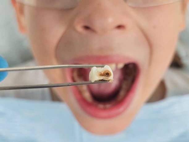 Best Emergency Dentist for Lost Fillings or Crowns in Saratoga Springs, NY